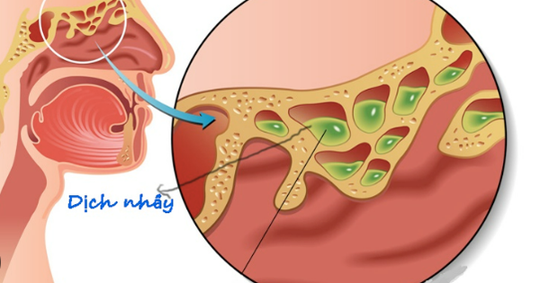 Luận giải giấc mơ bị nghẹt mũi theo giới tính và độ tuổi