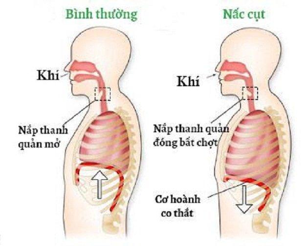Nấc cụt liên tục theo giới tính: Giải mã điềm báo cho nam và nữ